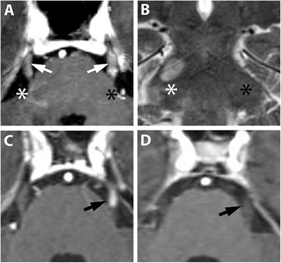 Cranial Nerve Enhancement in Multiple Sclerosis Is Associated With Younger Age at Onset and More Severe Disease